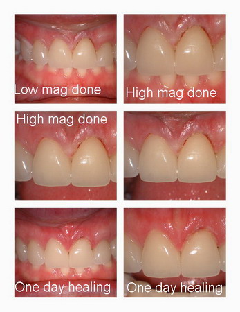 Insertion of Veneers Page5_resize_resize.jpg